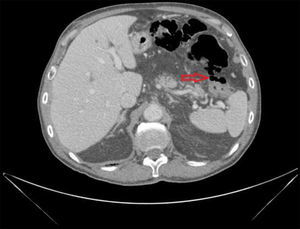Tomografía computarizada abdominal urgente describe gas libre intraperitoneal, sobre todo en flanco izquierdo, con engrosamiento de la pared duodenal.