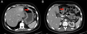 Tomografía axial computarizada de abdomen con engrosamiento de pared gástrica y duodenal. A) Corte a nivel gástrico. B) Corte a nivel duodenal.