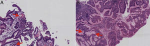 A) Biopsia de mucosa gástrica con microabscesos. B) Hiperplasia foveolar e infiltrado inflamatorio luminal.