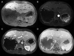 Resonancia magnética con gadolinio de un HHG en el lóbulo derecho. Las imágenes muestran un realce nodular centrípeto progresivo en las fases simple (A), arterial (B), portal (C) y tardía (D).