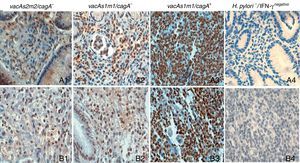 Inmunohistoquímica de la expresión de IFN-g en biopsias gástricas de pacientes con gastritis crónica y cáncer gástrico, contrateñidas con hematoxilina (10¿). A1-A4) Biopsias gástricas de pacientes con gastritis crónica. B1-B3) Biopsias gástricas de pacientes con cáncer gástrico. B4) Biopsia de amígdala, control negativo de la reacción (se omitió el anticuerpo primario).