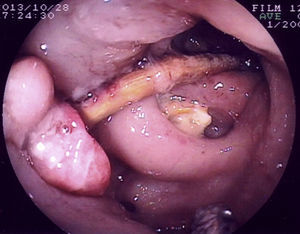 Imagen endoscópica de cuerpo extraño (hueso de pollo) impactado en orificio diverticular de colon sigmoide con intensa reacción inflamatoria.