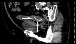 Tomografía computarizada abdominal con identificación de cuerpo extraño (hueso de pollo) que penetra la pared de colon sigmoide con engrosamiento de la fascia pélvica.