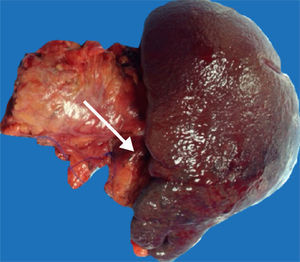 Pieza quirúrgica resultado de la pancreatectomía distal con esplenectomía. La punta de flecha señala una lesión de 2.8×2.1cm hacia la cola del páncreas.