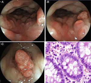 A y B) Colon descendente que muestra cambios inflamatorios, edema de mucosa, eritema en parches, con formaciones seudopolipoides y pérdida del patrón vascular. C) Lesión de aspecto polipoide en sigmoides con pérdida de la continuidad de la mucosa, edema y alteración de la vasculatura. D) Fotomicrografía que denota abundantes eosinófilos en la lámina propia, hasta 70 en un campo a gran aumento.