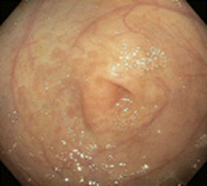 Imagen endoscópica de paciente con APLV, en donde se observa eritema de la mucosa a nivel del antro.