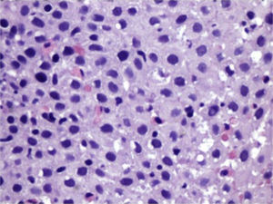 La tinción de hematoxilina y eosina mostraron >15 eosinófilos por campo de alto poder infiltrando la mucosa esofágica.