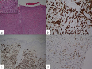 Biopsia excisional de lesión en cuero cabelludo que muestra un adenocarcinoma metastásico: a) hematoxilina-eosina ×4, detalle: hematoxilina-eosina, ×40; b) tinción inmunohistoquímica para CK7; c) tinción inmunohistoquímica para CK19, y d) tinción inmunohistoquímica para CDX2.