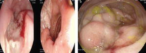 a) Endoscopia digestiva alta: úlceras esofágicas lineales en tercio superior del esófago. b) Endoscopia digestiva baja: lesión adyacente a válvula ileocecal, sobre-elevada y friable que condiciona estenosis.