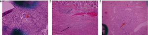 a) Estudio microscópico con hematoxilina-eosina, ×100: biopsia esofágica endoscópica con granuloma no caseificante en la submucosa (señalado con la flecha roja). b) Estudio microscópico con hematoxilina-eosina, ×100: infiltración leucocitaria crónica con afectación transmural: mucosa (flecha verde), submucosa (flecha azul) y capa muscular (flecha negra) en pieza quirúrgica (colon derecho e íleon terminal). c) Estudio microscópico con hematoxilina-eosina, ×100: granuloma no caseificante en intestino delgado (señalado con la flecha roja).