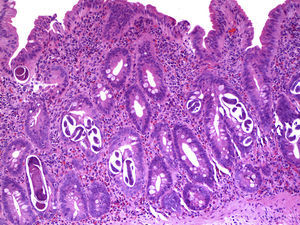 Mucosa duodenal con atrofia leve. Las criptas muestran numerosas larvas rabditiformes de Strongyloides stercoralis. La lamina propia muestra un infiltrado inflamatorio agudo y crónico con eosinofilia intensa (H&E, ×100).
