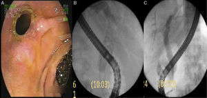 A) Hiperplasia en el extremo distal del stent. B) Colangiograma: coledocolitiasis múltiples menores a 10mm. C) Colangiograma final: vía biliar deshabitada.