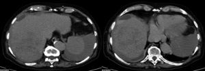 Tomografía axial computarizada de abdomen: hematoma subcapsular y hemoperitoneos.