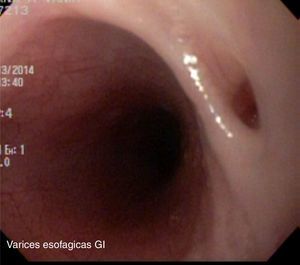 Imagen endoscópica de fístula traqueoesofágica previa al tratamiento.