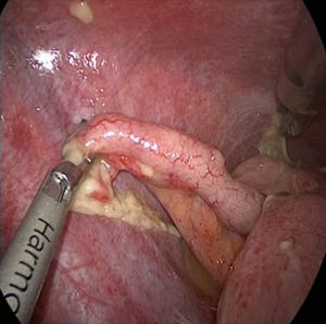 Apéndice cecal hiperémico con fibrina y líquido periapendicular secundario a peritonitis química.