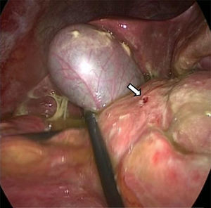 Úlcera duodenal perforada de 5mm en cara anterior de la primera porción duodenal (flecha blanca).