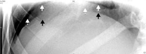 Cuadrante superior derecho de la radiografía abdominal donde se observa la silueta hepática (flecha negra), diafragma (flecha blanca) y aire libre subdiafragmático (fecha blanca punteada).