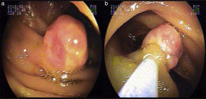 Enteroscopia doble balón: a) Lesión de 15mm de diámetro en yeyuno, y b) Inyección de la base de la lesión.