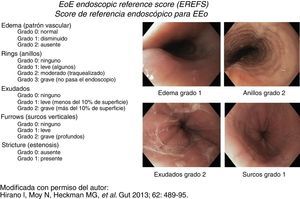 Score de referencia endoscópico para esofagitis eosinofílica con ejemplos. Modificado, con permiso del autor, de Hirano et al.14.