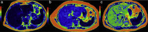 Mapas de color en 3 pacientes con diferentes grados de esteatosis: a) paciente con contenido normal de grasa: el color azul oscuro del hígado corresponde a la parte baja de la escala colorimétrica y a una cuantificación menor de 6% (normal); b) en este paciente el color azul claro se sitúa más arriba en la escala y el contenido de grasa está aumentado a un promedio de 17%; c) la imagen del tercer paciente asignó al hígado un color verde, indicativo de un alto contenido de grasa, que se cuantificó en 33%.