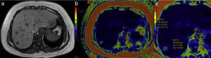 Adenoma hepático con grasa. a) La secuencia T1 muestra 3pequeñas lesiones focales en los segmentos 7 y 8 del hígado. El mapa de color para cuantificar grasa muestra que 2de ellas tienen tonos azulados en el centro (b) donde la concentración de lípidos fue de 37 y 19%, respectivamente (c). El diagnóstico histológico fue de adenoma HNF1.