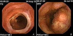 Enteritis por EICH. A) Estenosis secundaria a úlcera. B) Mucosa con pérdida de vellosidades, erosiones y úlceras.