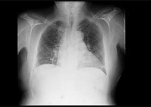 Radiografía de tórax en proyección posteroanterior, con atelectasia en el lóbulo pulmonar inferior izquierdo.