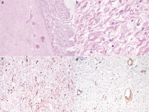 (a) Corte histológico con presencia de lesión ulcerada, localizada en la submucosa (hematoxilina & eosina, ×2). (b) La lesión muestra gruesos haces de colágeno, células ahusadas con núcleos de cromatina granular fina (hematoxilina & eosina, ×40); (c) Inmunorreacción para CD34 positiva, y (d) Actina de músculo liso negativa.