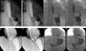 Evaluación radiológica con contraste en diferentes escenarios de la funduplicatura. A) Trago de bario con proyección antero-posterior de la funduplicatura tipo Nissen 360° en donde el fondo del estómago está envolviendo el esófago distal en forma completa. B) Trago de bario con esquema sobrepuesto. C) Trago de bario con proyección antero-posterior de la funduplicatura tipo Nissen 180° en donde el fondo envuelve parcialmente el esófago distal. D) Trago de bario con esquema sobrepuesto. E) Trago de bario con proyección antero-posterior de una funduplicatura tipo Nissen 360° con migración tipo i, observándose la herniación por arriba y la UEG por debajo del diafragma. F) Trago de bario con esquema sobrepuesto. G) Trago de bario con proyección antero-posterior de una funduplicatura tipo Nissen 180° con migración tipo i, observándose la herniación por arriba y la UEG por debajo del diafragma. H) Trago de bario con esquema sobrepuesto. Tomado de Raeside et al.34.