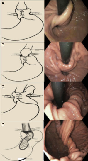 Tipos de funduplicatura fallida (clasificación de Horgan). A) Tipo Ia: hernia sin herniación de la funduplicatura. B) Tipo Ib: con herniación de la funduplicatura. C) Con desplazamiento paraesofágico. D) Defecto en la formación de la plicatura. Tomado de Horgan y Pellegrini30.