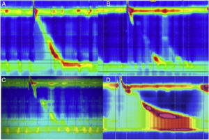 A) Deglución normal, peristalsis normal con EEI competente en paciente con funduplicatura. B) Deglución normal, peristalsis fallida con EEI incompetente en paciente con funduplicatura. C) Deglución normal, amplitud disminuida y falta de relajación del EEI en paciente con funduplicatura. D) Deglución normal, amplitud aumentada, falta de relajación del EEI y evidente obstrucción del tracto de salida con incremento de la presión intrabolo (frontalización).