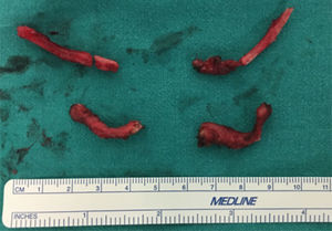 Resección de ambas apófisis estiloideas (parte superior de la imagen) y de ambas astas del hueso hioides (parte inferior de la imagen).