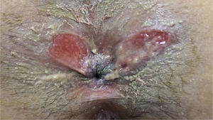 Úlceras perianales de la paciente de localización atípica.