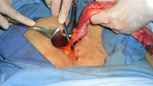 Ligadura y corte del pedículo del quiste en el mesenterio del recto sigmoides.