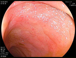 Mucosa nodular duodenal con aspecto atrófico.