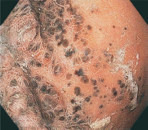 Cuerpo de mucosa gástrica con múltiples lesiones melanóticas de diversos tamaños.