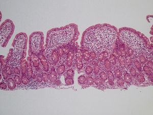 Linfocitosis intraepitelial asociada a pérdida de vacuolas de mucosecreción, hiperplasia de criptas glandulares y atrofia vellositaria moderada (H&E, ×20).