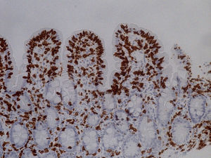 Linfocitosis intraepitelial (>30 linfocitos/100 enterocitos) (IHQ-CD3, ×40).
