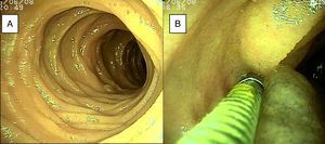 A) Se observa mucosa normal de duodeno. B) Mucosa de yeyuno tatuada con tinta de carbono orgánica.