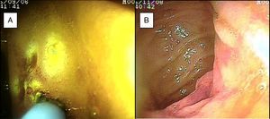 A) Mucosa de duodeno con angiodisplasias diminutas con aplicación de argón plasma. B) Presencia de angiodisplasia en la mucosa de yeyuno.