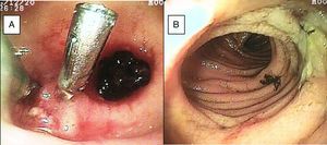A) Divertículo de íleon con coágulo adherido y vaso visible con 2 hemoclips. B) Úlcera benigna en íleon.