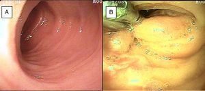 A) Mucosa de íleon con edema e hiperemia, y reporte histopatológico de ileítis inespecífica en paciente con dolor abdominal crónico. B) Laceración profunda de la mucosa de yeyuno tratada con 2 hemoclips.
