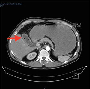 TAC de abdomen en fase contrastada. La flecha señala la presencia de gas en el interior de la vesícula biliar y litos.