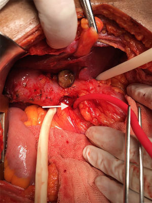Fístula colecisto duodenal. La flecha señala la comunicación hacia duodeno.