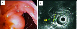 Imágenes de lesión ampular. A) Duodenoscopia que muestra lesión subepitelial. B) Visión por ultrasonido endoscópico de lesión hipoecoica, heterogénea, cubierta en su totalidad por mucosa y respetando la muscular propia del duodeno (flecha amarilla); 21.0×16.9mm.