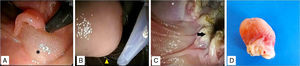 Úlcera cubierta de fibrina de aproximadamente 1.5cm de bordes irregulares con otra más pequeña en espejo, se aprecian otras zonas de fibrina proximales.
