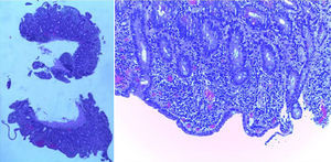 Biopsias del intestino delgado mostrando atrofia vellositaria e infiltración linfocítica crónica de la lámina propia (hematoxilina-eosina ×15).