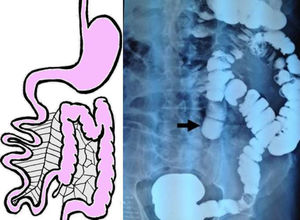 Colon por enema. El ciego, colon ascendente, transverso y descendente se encuentran en el lado izquierdo del abdomen (flecha negra), compatible con malrotación intestinal tipo no rotación.