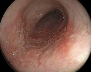 Endoscopia con luz blanca de lesión esofágica temprana.