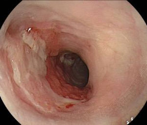 Control endoscópico posterior a DES (30 días). Paciente recibió terapia profiláctica de estenosis con corticoides oral por 4 semanas.